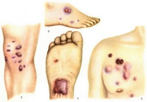 A kötőszövet, a szubkután és más lágy szövetek daganatai - Cirrózis - April
