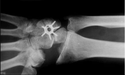 Kienbock leczenia chorób, objawów i diagnostyki (diagnoza) leczenie choroby Kienbock, objawy i diagnostyka