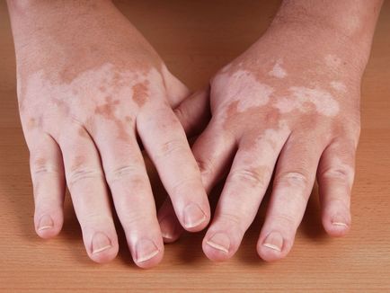 bielactwo leczenie objawów zdjęcia że choroba ta powoduje (foto) leczenie bielactwa zdjęcia objawy że choroba, przyczyny