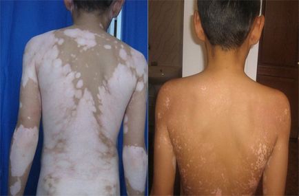 bielactwo leczenie objawów zdjęcia że choroba ta powoduje (foto) leczenie bielactwa zdjęcia objawy że choroba, przyczyny