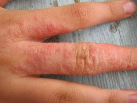Milyen betegségre utalnak a vörös foltok?