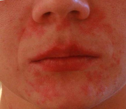 Vörös foltok jelentek meg a férfiak arcán Bőrgomba - Canesten