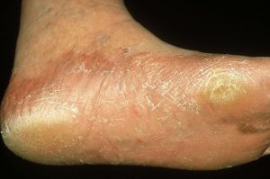 kenőcs kezelésére lábak cukorbetegség
