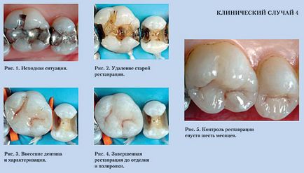 O kompozytowych uzupełnień współczesna medycyna artykuły stomatologiczne (emalia) O kompozytowych uzupełnień nowoczesnej stomatologii artykuły medycyna