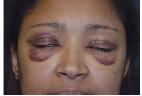Powikłania po Blepharoplastyka powiek obrzęk, wywracania, blizny, blizny (ektropium wieku po odsysanie tłuszczu) Powikłania po Blepharoplastyka powiek obrzęk, wywinięcie, blizny, blizny
