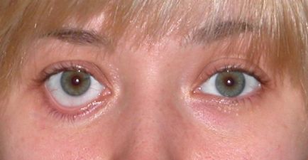 Powikłań po odsysanie tłuszczu, obrzęku powiek odwracania, blizny, blizn (blizn po odsysanie tłuszczu górnej powieki) Powikłania po Blepharoplastyka powiek obrzęk, wywinięcie, blizny, blizny