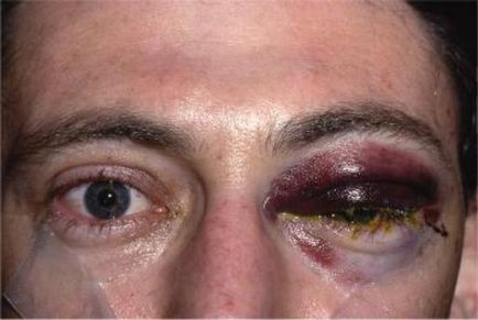 Powikłania po Blepharoplastyka powiek obrzęk, wywracania, blizny, blizny (powikłania następujące odsysanie tłuszczu) Powikłania po Blepharoplastyka powiek obrzęk, wywinięcie, blizny, blizny