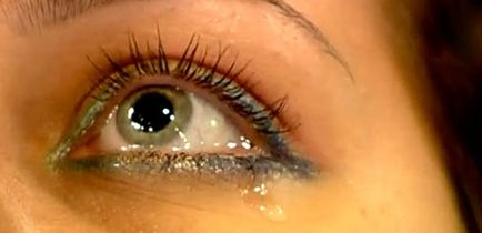 Powikłania po odsysanie tłuszczu, obrzęku powiek wywracania, blizny, blizny (różne powiek po odsysanie tłuszczu) Powikłania po Blepharoplastyka powiek obrzęk, wywinięcie, blizny, blizny