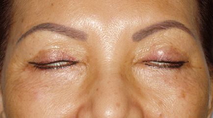 Powikłania po odsysanie tłuszczu, obrzęku powiek wywracania, blizny, blizny (obrzęk) Powikłania po Blepharoplastyka powiek obrzęk, wywinięcie, blizny, blizny