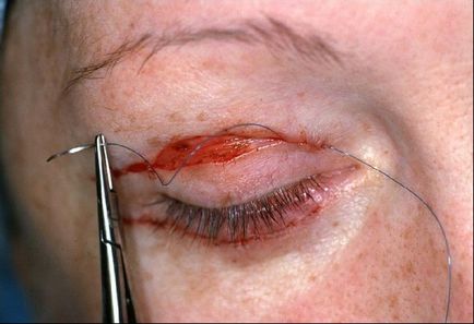 Powikłań po odsysanie tłuszczu, obrzęku powiek odwracania, blizny, blizn (blizn po odsysanie tłuszczu górnej powieki) Powikłania po Blepharoplastyka powiek obrzęk, wywinięcie, blizny, blizny
