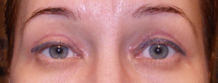 Powikłań po odsysanie tłuszczu, obrzęku powiek odwracania, blizny, blizn (blizn po odsysanie tłuszczu górnej powieki) Powikłania po Blepharoplastyka powiek obrzęk, wywinięcie, blizny, blizny