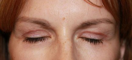 Powikłania po odsysanie tłuszczu, obrzęku powiek wywracania, blizny, blizny (blizny) Powikłania po Blepharoplastyka powiek obrzęk, wywinięcie, blizny, blizny