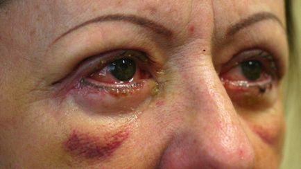 Powikłań po odsysanie obrzęk powiek, odwracania, blizny, rany (bez wynik po dolnej powieki blefaroplastyką) Powikłania po Blepharoplastyka powiek obrzęk, wywinięcie, blizny, blizny