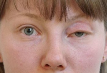 Powikłań po odsysanie obrzęk powiek, odwracania, blizny, rany (ektropium po blefaroplastyką) Powikłania po Blepharoplastyka powiek obrzęk, wywinięcie, blizny, blizny