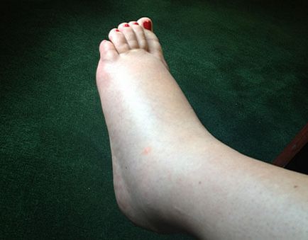 A bal láb duzzanata okozza folyadék a térdízület homeopátia kezelésében