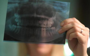 dentystyczne rentgenowskie w czasie ciąży - czy jest możliwe, aby zrobić zdjęcie we wczesnych stadiach (ciąży) dentystyczne rentgenowskie w czasie ciąży - czy to możliwe, aby zrobić zdjęcie z wczesnych stadiach