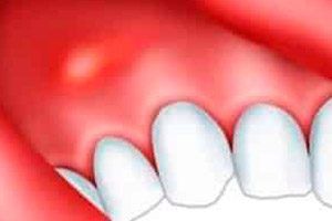 Szczoteczka przetoka po usunięciu wygląda, leczenia domowego (po) Dental przetoka po usunięciu wygląda, leczenia domowego