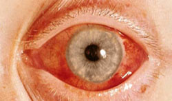 oftalmologie atac acut de glaucom)