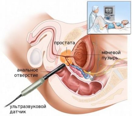rektális ultrahang vizsgálat diclofenac a prosztatitis oktatásból