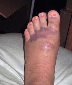láb zúzódás tünetei