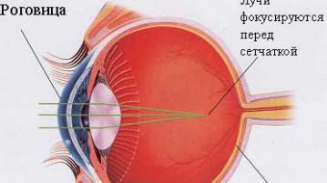 Cum poți restabili miopia medie, Metode de restabilire a vederii în miopie