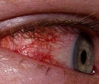 látásélesség kornorma hogy milyen betegség esetén romlik a látás