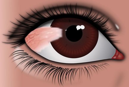 video cu chirurgia ochiului cu laser