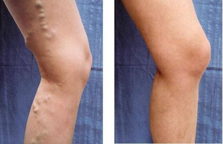 prevenirea venelor vene pe picioare insuficienta venoasa cronica ceap 6