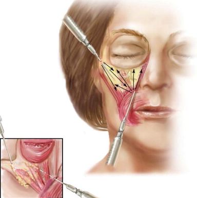 Proceduri pentru îndepărtarea ridurilor faciale deasupra buzei
