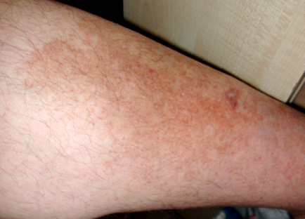 Roșeață pe picioare cu vene varicoase - Luxații April - Petele albastre pe picioarele varicoasei