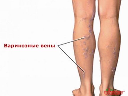 tratamentul pielii întunecând în varicoza)