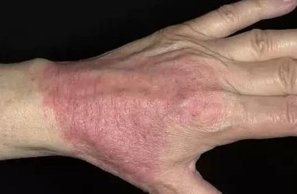 moderate to severe plaque psoriasis commercial