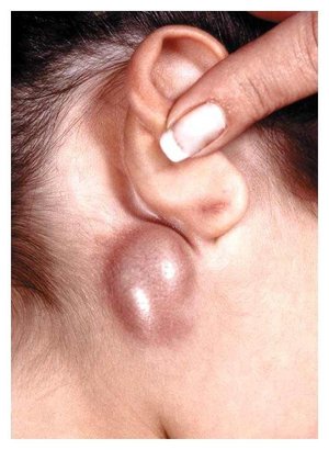 varicoza în spatele urechii