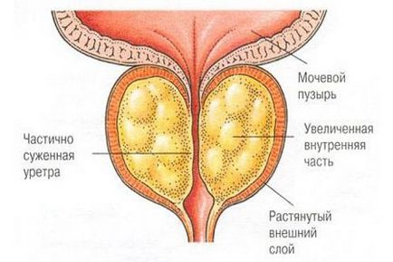 Prostata erectie Pagina 2, Erecții nocturne cu prostatită