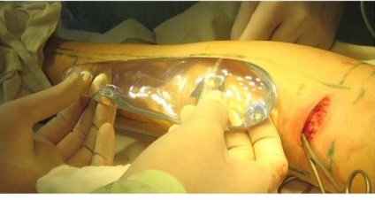 Як виправити криві ноги, чи можна це зробити з операцією і без у дитини і дорослого, дівчат і