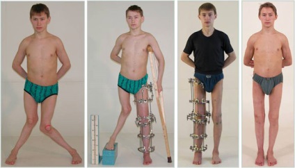 Як виправити криві ноги, чи можна це зробити з операцією і без у дитини і дорослого, дівчат і