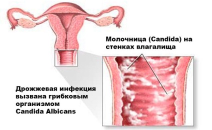 Як виглядає молочниця у жінок і у чоловіків