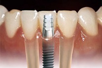 Відторгнення і рухливість імпланта, статті, зрозуміла стоматологія для пацієнтів онлайн діагност,