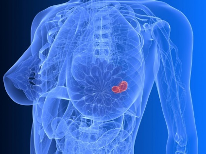 Види хіміотерапія при раку молочної залози