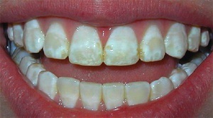 Чим відбілити зуби види відбілювачів зубів, правила використання в домашніх умовах,
