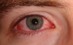 Кандидоз очей, перші ознаки, симптоми і методи лікування