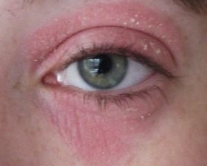 Кандидоз очей, перші ознаки, симптоми і методи лікування