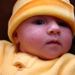 Прищі у грудничка прищі на обличчі у немовляти
