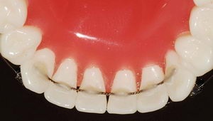 Зуби після брекетів закріплення результату - про виправлення прикусу і брекети