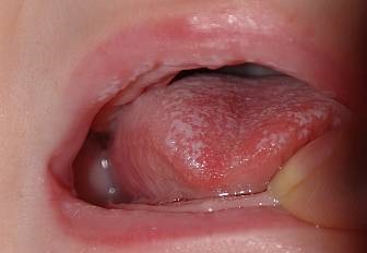 Молочниця в роті у дитини причини і способи лікування