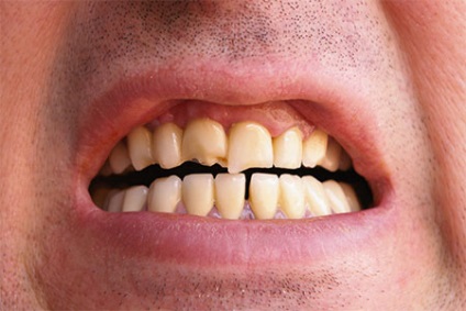 Вартість відновлення і нарощування зубів в уфа фото до і після, відео, ціна нарощування