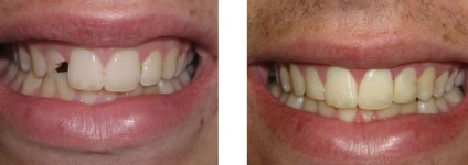 Вартість відновлення і нарощування зубів в уфа фото до і після, відео, ціна нарощування