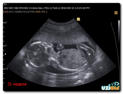 Узі на 21 тижні вагітності; норми, дівчинка, фото
