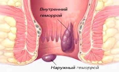 Геморой зовнішній, ніж лікувати і як уникнути рецидивів