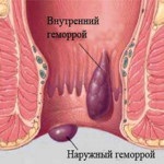 Геморой зовнішній, ніж лікувати і як уникнути рецидивів